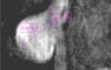 Occasional growth of rat aneurysm