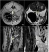 Aneurism seen 6 weeks after operation