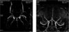 MR angiography (MRA)