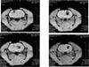 T2* Intracerebral Hemorrhage -model
