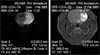 Ischemia DWI image, and postcontrast T1 image